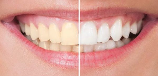 Blanqueamiento dental: Todo lo que debes saber