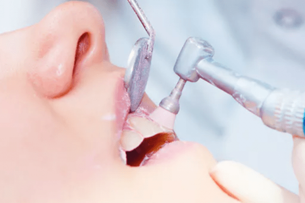Ojo con las caries interproximales: no las ves pero están ahí