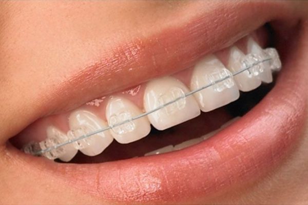 Ortodoncia: tratamientos que no perjudican la estética