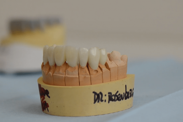 Rehabilitación oral: Coronas vs. Carillas