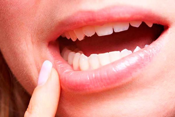 Sí, el estrés está afectando tu salud bucal
