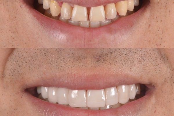 ¿Cuándo es necesario una reconstrucción dental?
