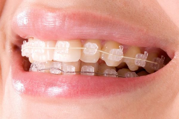 Brackets de Zafiro: ¿Conoces sus beneficios?