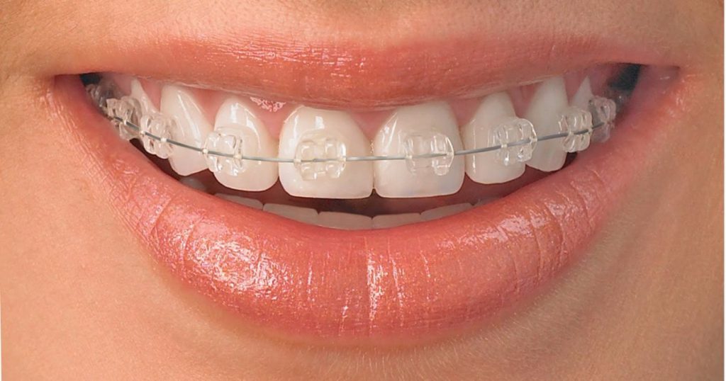 Brackets De Zafiro ¿Conoces Sus Beneficios? Clínica Dental Alberto