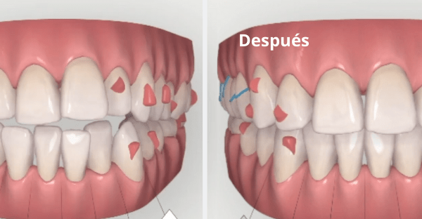 ¿Quieres ver como quedaría tu sonrisa corregida? ¡Con este tratamiento puedes!