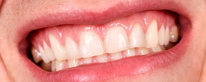 ¿Es o no una urgencia dental? Aprende a reconocerlas